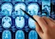 Un bărbat trăieşte fără 90% din creier şi merge la job în continuare. Medicii sunt şocaţi