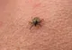 Primul caz de boala Lyme din acesta an, din România. Victima, o fetiţă de cinci ani