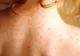 FRESH REFRESH. Nu neglijați dermatita atopică, boala care îi afectează și pe copii, și pe adulți