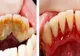 Cum scapi de tartru cu 3 alimente banale. Dentiștii ți-au ascuns mereu asta!