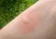 Ce boli pot transmite țânțarii. Dacă ai aceste simptome, mergi la medic