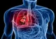Acesta este alimentul care ucide 85% din celulele cancerului pulmonar