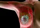 5 simptome timpurii ale cancerului. Probabil nu le-ai observat