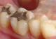 Plombele dentare vor dispărea. Tratamentul revoluţionar care REGENEREAZĂ dinţii