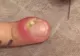 Avea o unghie infectată şi a spart buba ce s-a format pe deget. A leşinat când a văzut ce a ieşit