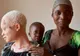 Vânată pentru culoarea pielii. Coșmarul unei femei albinoase din Africa 