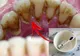 Cum scapi RAPID de tartru de pe dinți fără să mergi la dentist