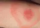 Primele semne că ai fost mușcat de căpușă! Mergi de urgenţă la medic dacă îţi apare asta pe piele