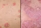 Planta miraculoasă care tratează psoriazisul, eczemele, dermatita şi alergiile pielii