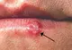 Cum să scapi rapid și eficient de HERPES cu un singur aliment. Vei rămâne UIMIT!