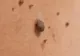 Iată cât de periculoase sunt aluniţele de pe corp! Greşelile pe care le fac toţi românii