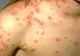 Zece cazuri noi de rujeolă confirmate în Vaslui. În toate cazurile, copiii nu au fost vaccinaţi