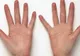 Tot ce trebuie să știți despre psoriazis, afecțiunea care lovește când nu te aștepți