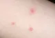 Patru insecte care te pot ucide cu înţepăturile lor! Mergi de urgenţă la medic dacă îţi apar semne