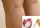 Remediul din două ingrediente care te ajută să scapi de varice DEFINITIV
