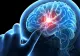 Semne care prevestesc un accident vascular cerebral