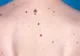 Semnele de alarmă care anunță cancerul de piele
