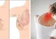 Primele simptome ale cancerului mamar. Când e durerea de sân un semn de alarmă