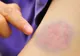 De ce apar vânătăi atunci când o persoană suferă de leucemie? Simptomele ascunse