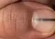 Credea că e o pată banală sub unghie, dar i s-a spus să meargă la doctor. Avea o boală cumplită 