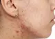 O substanță cancerigenă, descoperită în unele produsele împotriva acneei ale unor firme de cosmetice de top. Cine a dat alarma