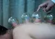Ce este terapia cu ventuze, des utilizată de sportivii de performanță pentru recuperare după efort VIDEO