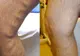 Verifică şi tu dacă suferi de TROMBOZĂ VENOASĂ. Completează online chestionarul