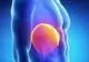 10 semne de alarmă ale cancerului hepatic
