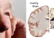 Descoperire de senzație în studiul bolii Alzheimer