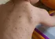 Situaţia devine alarmantă: Peste 200 de noi cazuri de rujeolă, într-o singură săptămână