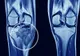 Tot mai multe cazuri de CANCER OSOS: cauze, simptome, tratament 