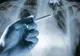 SEMNUL care anunţă cancerul pulmonar
