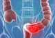 Semnele cancerului de colon pe care NU trebuie să le ignori