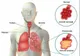 Ai aceste simptome? Mergi de urgenţă la medic. E PNEUMONIE!