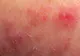 Dermatita atopică. Cauzele nebănuite prin care pielea poate arăta aşa 