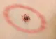 Boala Lyme. Descoperire fabuloasă a oamenilor de ştiinţă
