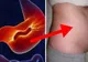 Bacteria care distruge stomacul. Se poate afla în corpul tău fără să îţi dai seama