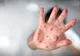 Bilanț actualizat al epidemiei de rujeolă: aproape 20.200 de cazuri