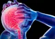Accident vascular cerebral - metoda care îţi poate salva viaţa