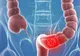 Produsul pe care îl consumi zilnic și care te îmbolnăvește de cancer de colon