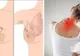 Primele simptome ale cancerului mamar. Când e durerea de sân un semn de alarmă