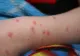 ALERTĂ: peste 100 de cazuri noi de rujeolă au fost depistate în ultimele zece zile în România