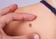 Regula ABCDE - Care sunt semnele pe care dacă le observi la o aluniță ar trebui să mergi de urgență la medic