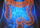 Medicii au descoperit o posibilă cauză a creșterii cazurilor misterioase de cancer de colon la persoanele sub 50 de ani