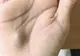 Dacă vezi o astfel de umflătură în palmă, mergi de urgenţă la spital!