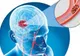 Semne ale atacului cerebral care apar cu mult ÎNAINTE de declanşare. Nu le ignora!