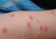 RUJEOLA, amenințare iminentă, urmează 12-24 de luni foarte dificile. Alertă sanitară globală