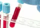 Grupa de sânge îți arată dacă vei face cancer. Cine are cel mai mare risc?