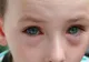 Ce este anafilaxia? Poate duce la deces în cazul în care nu se intervine medical