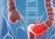 Cancerul de colon: Cauze și simptome